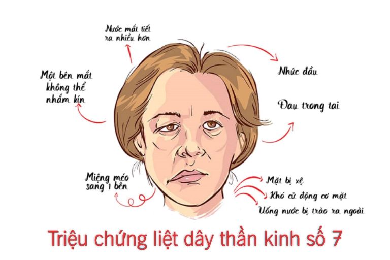 Liệt dây thần kinh số 7 ngoại biên và cách điều trị