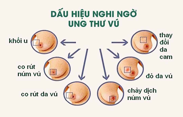 Dấu hiệu khẳng định ung thư vú giai đoạn cuối