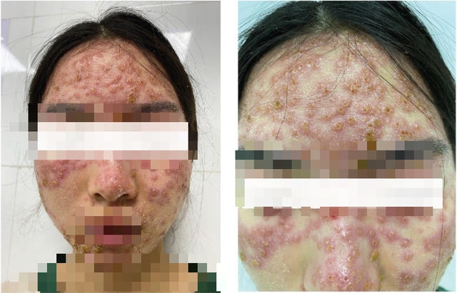 Đắp mặt nạ detox, người phụ nữ bị bội nhiễm da Herpes simplex - Ảnh 1.