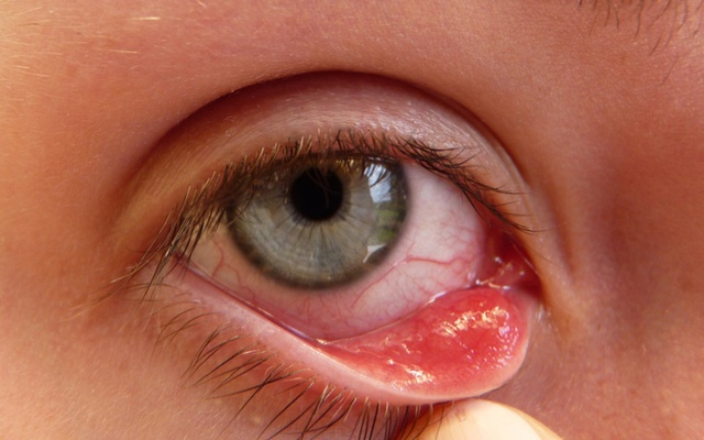 Những bệnh lý về mắt thường gặp sau bão lũ - Ảnh 1.