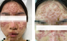 Đắp mặt nạ detox, người phụ nữ bị bội nhiễm da Herpes simplex