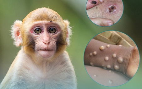 Bệnh đậu mùa khỉ ảnh hưởng tới thai kỳ thế nào?